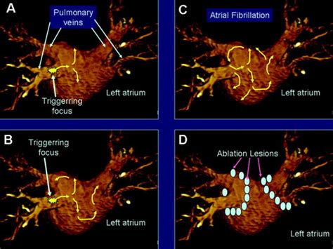 Atrial Fibrillation Catheter Ablation