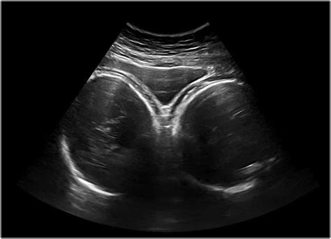 A two-dimensional ultrasound image showing twin gestation with one... | Download Scientific Diagram