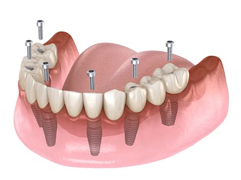 All-On-4 Dental Implants - Artistic Dentistry