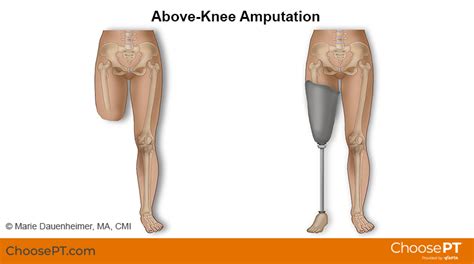 Guide | Physical Therapy Guide to Above-Knee Amputation (Transfemoral ...