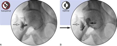 Intraarticular Hip Injection—Anterior Approach: Fluoroscopic Guidance | Musculoskeletal Key