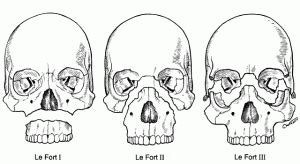 GUIAS DE MEDICINA : FRACTURAS DE LEFORT