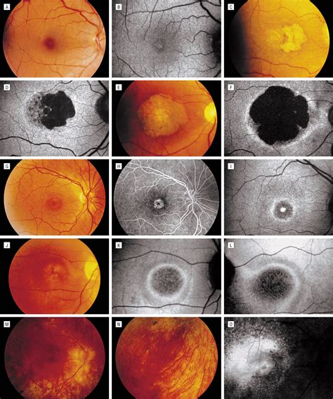 Autosomal Dominant Cone and Cone-Rod Dystrophy With Mutations in the Guanylate Cyclase Activator ...