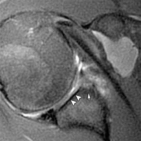 Imaging the Glenoid Labrum and Labral Tears | RadioGraphics