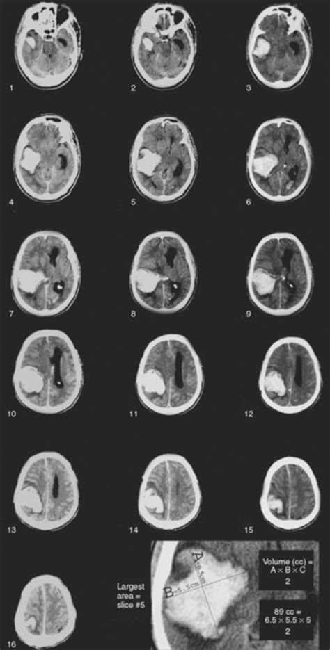 Spontaneous Intraparenchymal Hemorrhage | Radiology Key