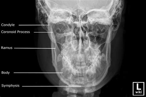 Mandible Radiographic Anatomy - wikiRadiography