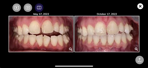 Open Bite Finally Almost Closed : r/Invisalign