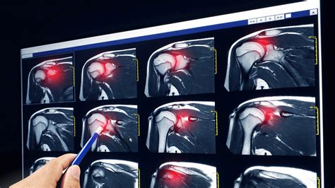 When not to have rotator cuff surgery | Reflex Health