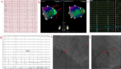 PVC with acute successful ablation near the atrioventricular node (AVN)... | Download Scientific ...