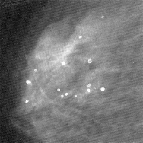 A mammogram of female breast, revealing micro-calcifica | Open-i