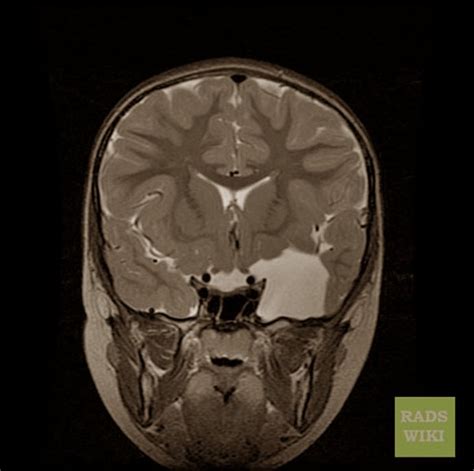 Arachnoid Cyst - Pictures, Symptoms, Causes, Treatment - (2018 - Updated)