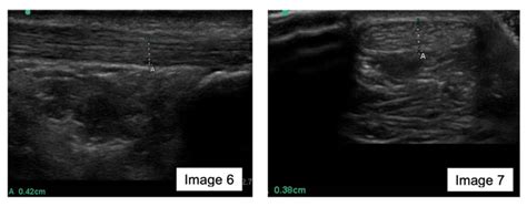 Case study - Achilles tendon - Sports Medicine Ultrasound Group