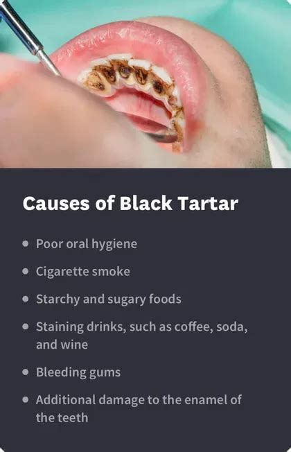 Black Tartar: Causes, Symptoms & Treatment Options | Byte®