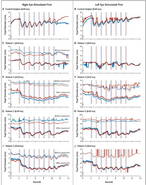 Representative Results of Pupillometry in a Control Subject and before ...