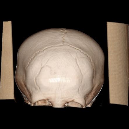 Cranial sutures - normal | Radiology Case | Radiopaedia.org