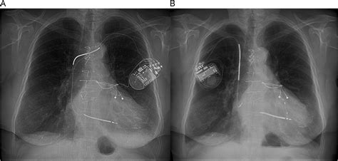 Epicardial leads in adult cardiac resynchronization therapy recipients ...