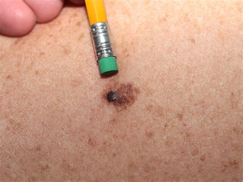 Moles - Causes, Types, Abnormal, Cancerous Moles