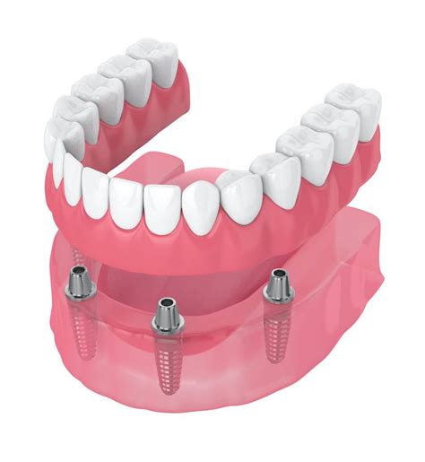 Implant-Retained Dentures: Benefits, Examples, and Cost