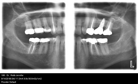 What are Bitewing Xrays and Why Do You Take Them?