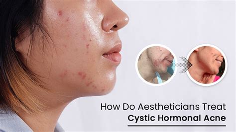 How Do Aestheticians Treat Cystic Hormonal Acne