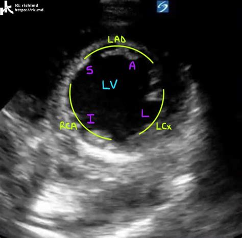 Cardiac Transthoracic Echocardiography (TTE) - Summary And Labeled ...