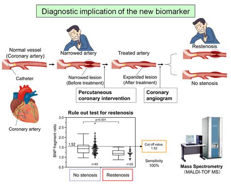 Development of a new blood test to detect ischemic heart disease | The University of Tokyo