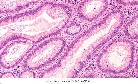 Microscopic Histology Tubular Adenoma Adenomas Premalignant Stok Fotoğrafı 577762198 | Shutterstock