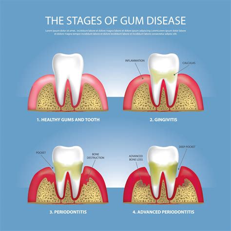 Human teeth Stages of Gum Disease Vector Illustration 2441651 Vector Art at Vecteezy