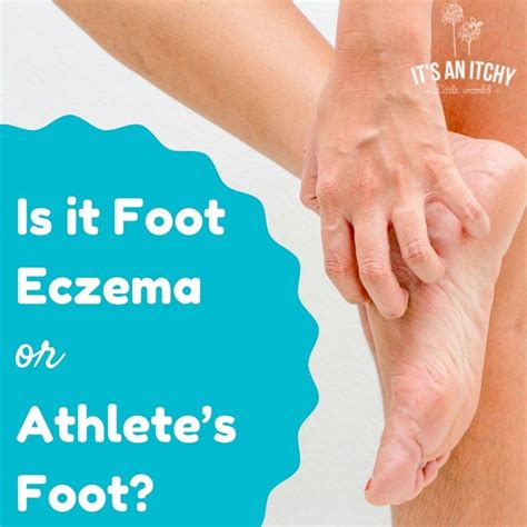 Is it Foot Eczema or Athlete’s Foot? | Natural cough remedies, Herbal cure, Athletes foot remedies