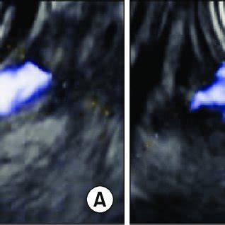 Esophageal varices. (A) Endoscopic image shows large esophageal ...