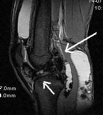 Pigmented Villonodular Synovitis-MRI - Sumer's Radiology Blog