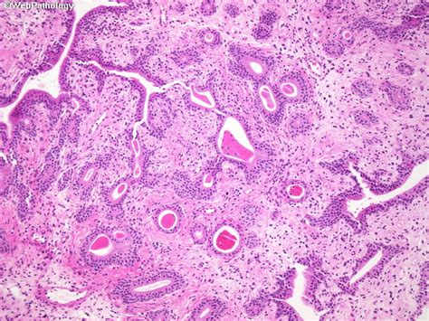 Webpathology.com: A Collection of Surgical Pathology Images