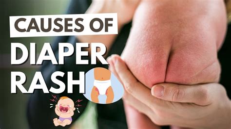 Diaper Rash