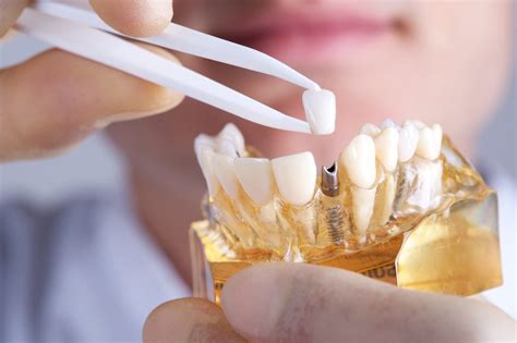 How To Care For Your Dental Implants - Mint Dental