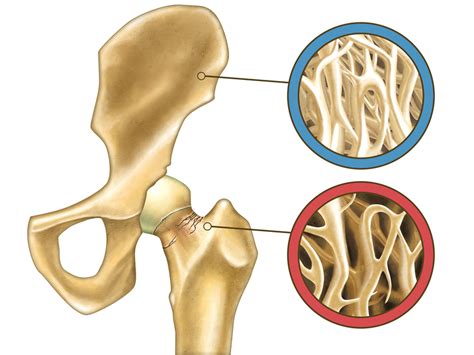 Are You at Risk for Osteopenia? Symptoms May Not Tell the Story ...