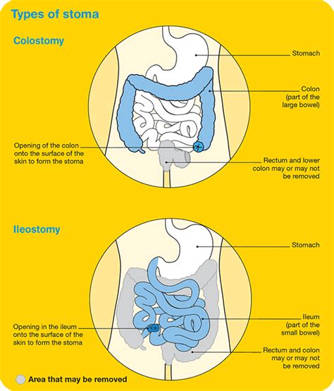 Coping with diet & bowel changes | Bowel Cancer - Cancer Council Victoria