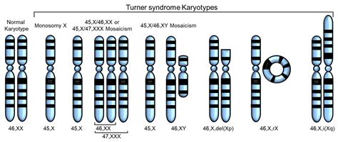 Monosomy Turner Syndrome