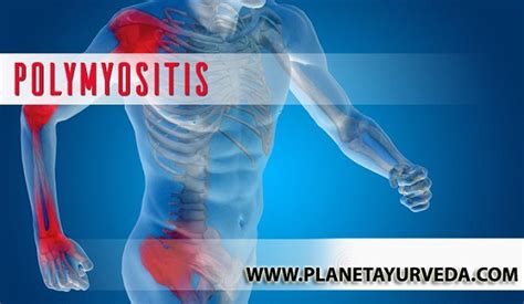 Polymyositis- Causes, Symptoms, Diagnosis And Natural Treatment