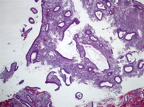 Pathology Outlines - Disordered proliferative