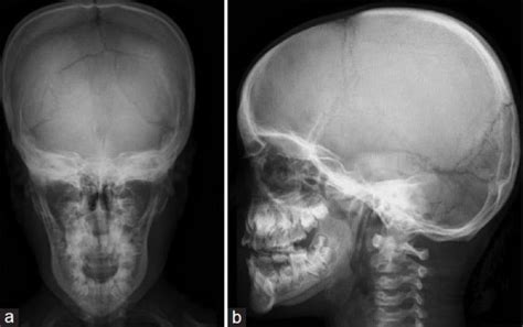 CLEIDOCRANIAL DYSPLASIA | buyxraysonline