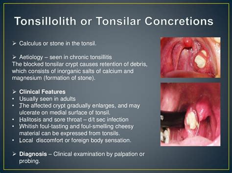 palatine tonsil, its anatomy, diseases and their management