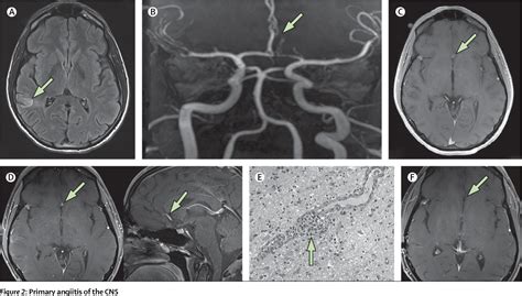 Figure 2 from Primary angiitis of the CNS | Semantic Scholar