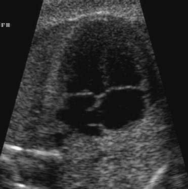 Foramen Ovale