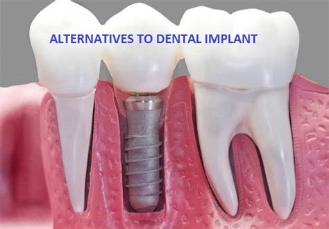 Alternatives to Dental Implants - Dr Muzzafar Zaman