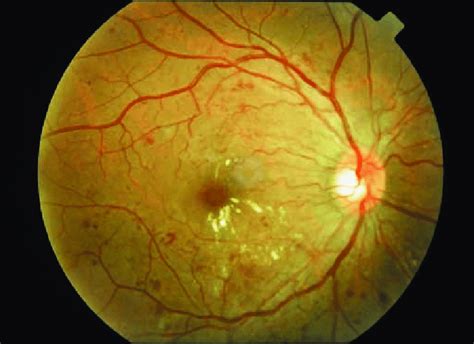 Diabetic Retinopathy Fundus Photo