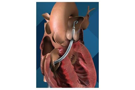 Impella - RP - Impella Heart Pumps - Minimally Invasive ...