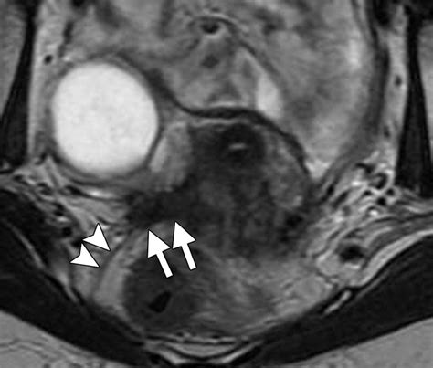 Endometriosis Imaging Mri at Lisa Bean blog