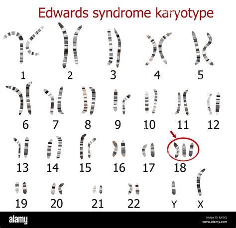 Trisomy 18 Edwards Syndrome Causes Symptoms Life