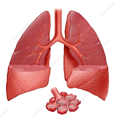 Lungs With Fluid - Stock Image - C001/4978 - Science Photo Library