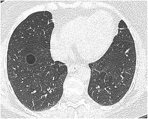 Pulmonary cysts identified on chest CT: are they part of aging change ...